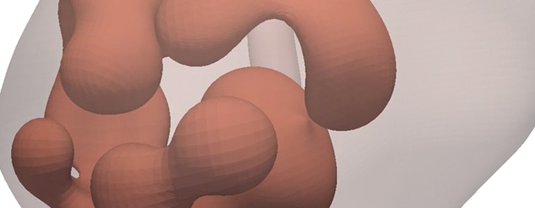 Tumore alla prostata, dai laboratori unipv la simulazione al computer (video)